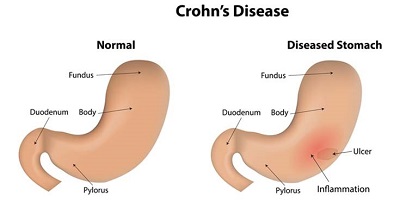 Thế nào là bệnh Crohn